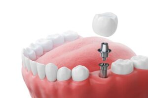 implantologia dentale Carpiano